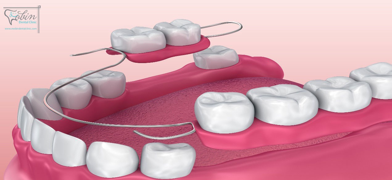 پروتز های موقت دندان به شکل تعداد محدود دو تا سه تایی نیز قابل ساخت هستند